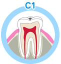 虫歯の進行状態について 初期虫歯（C1＝シーワン）