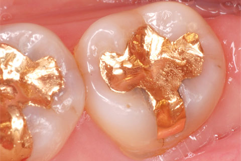 ゴールドインレー（金属）による虫歯治療