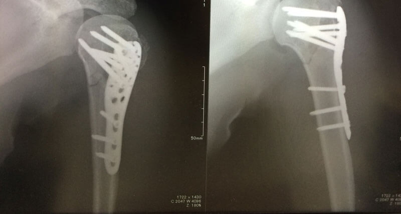 上腕骨近位端骨折：手術後